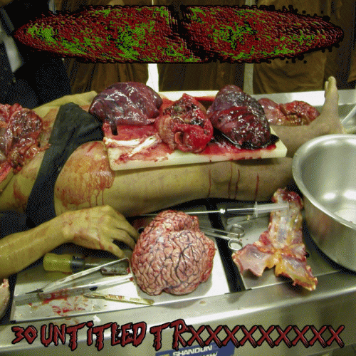 Estenosis Aortica : 30 Untitled Trxxxxxxxxx